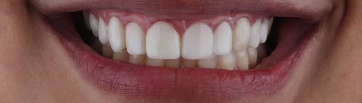 Sorriso antes, com facetas antigas