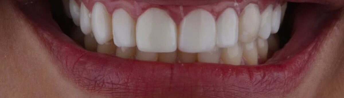 Sorriso depois da troca das facetas