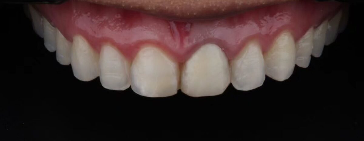 Facetas antigas removidas e dentes preparados